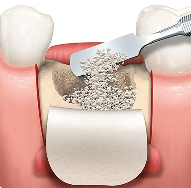 Bone Grafting / Ridge Augmentation