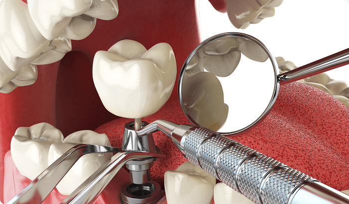 Dental Implant Surgery