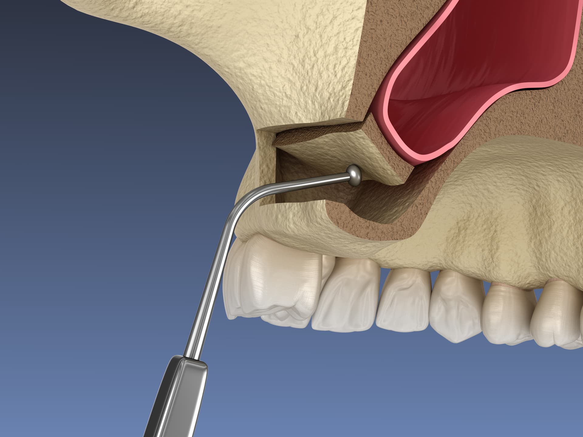 Sinus Lift Surgery