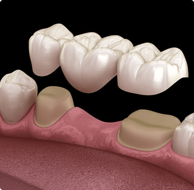 Dental Bridges