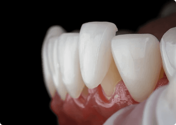 Dental Crowns