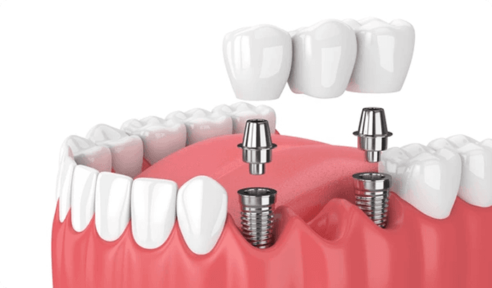 Dental Implants & Implant Crowns