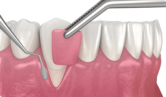 Gum & Bone Grafting