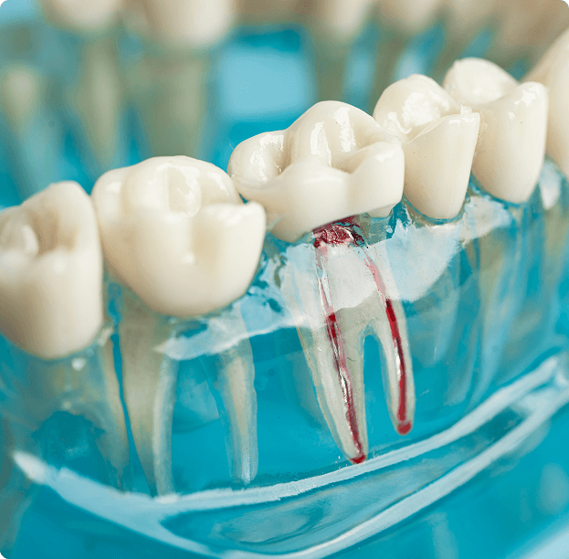 Root Canal Therapy
